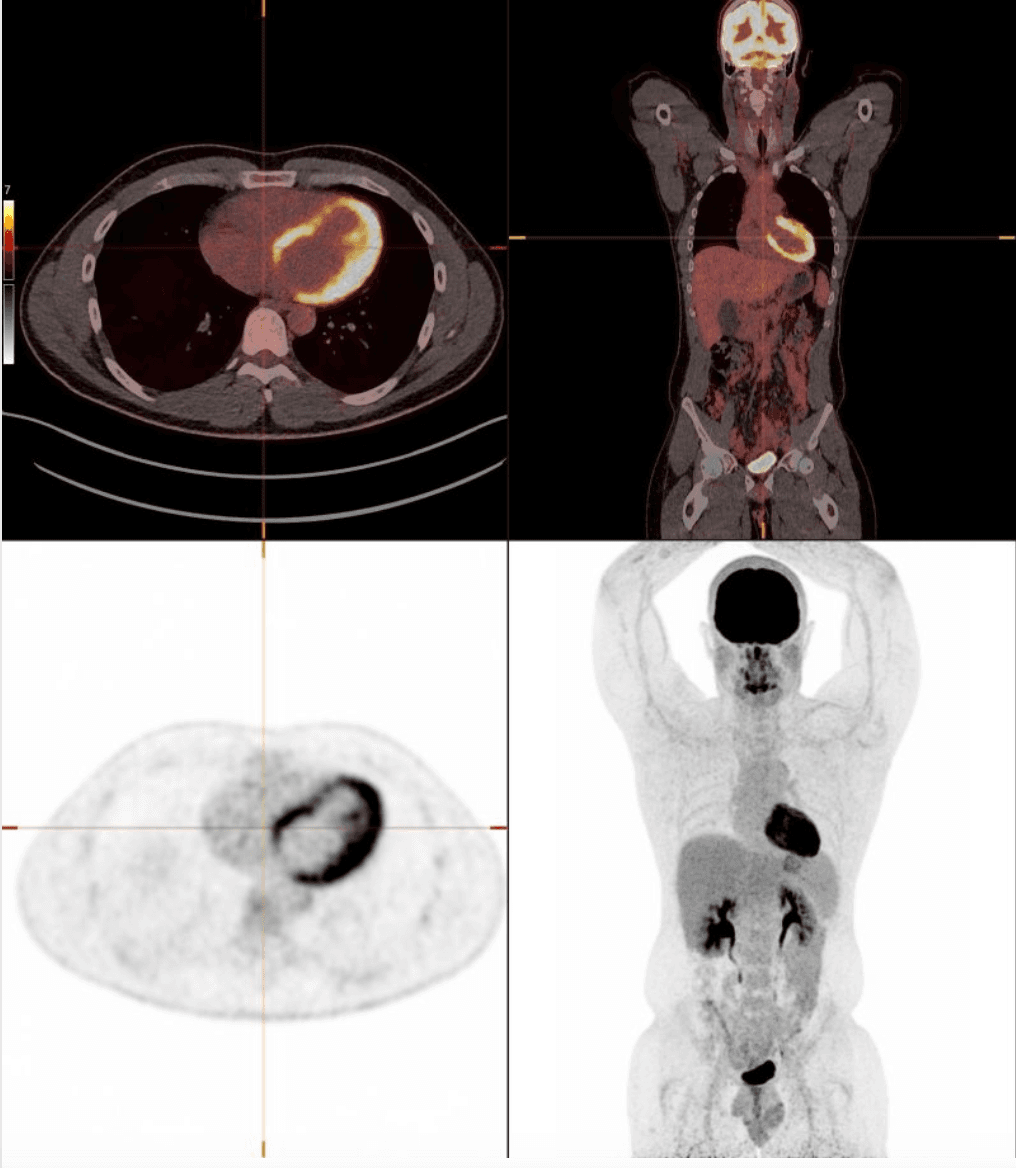 PET-CT — nuclear radiology
